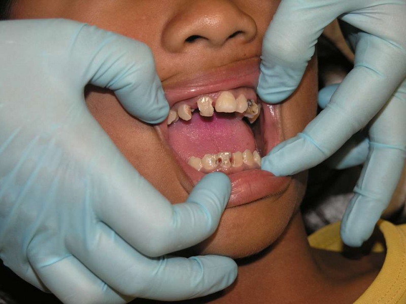 洗牙多久可以补牙洗牙后补牙要注意什么